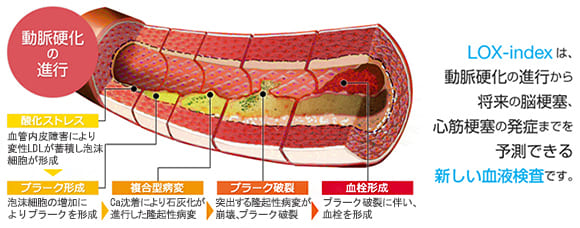脳梗塞・心筋梗塞発症リスク検査