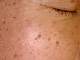 脂漏性角化症（老人性疣贅、老人性イボ）