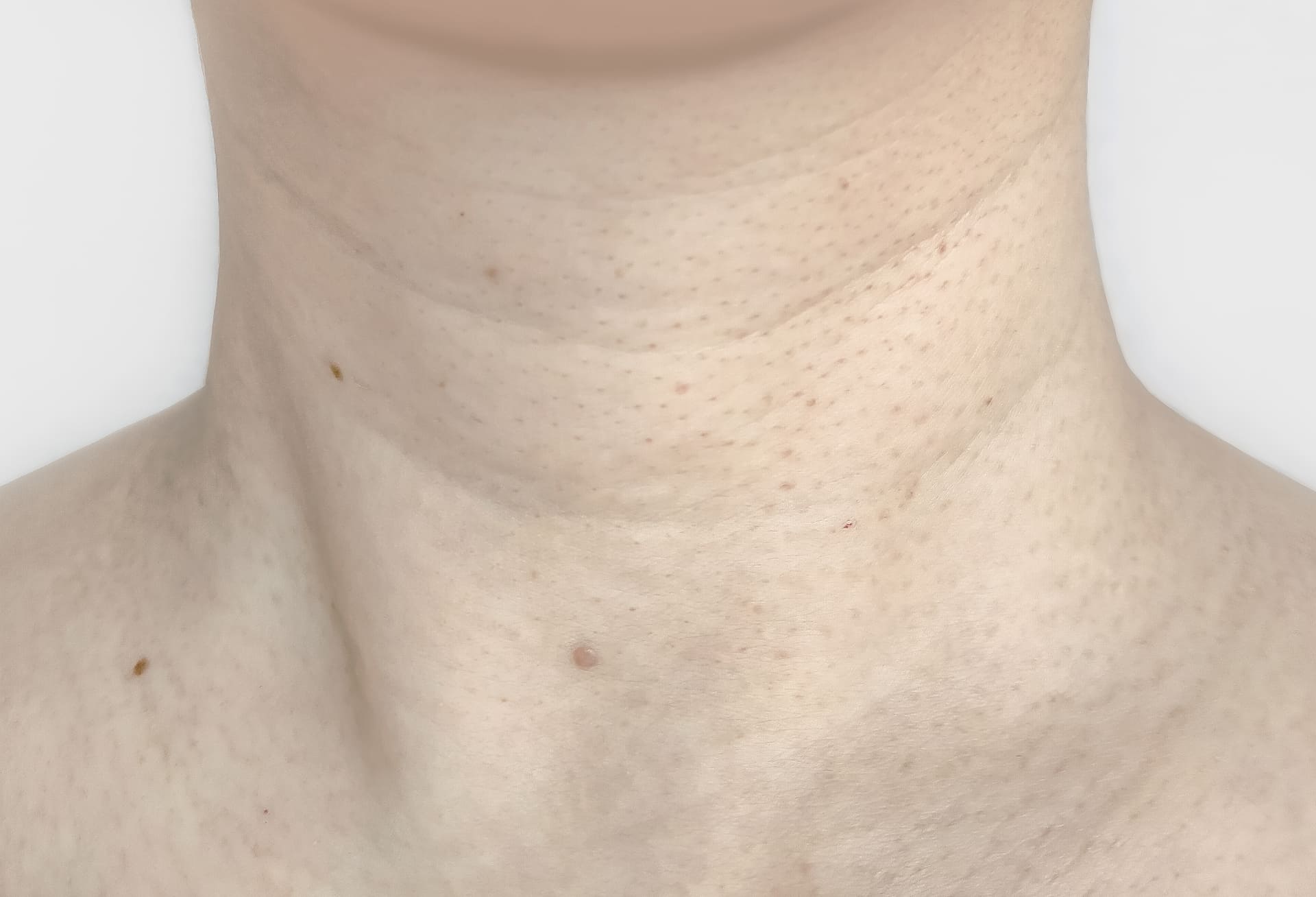 アクロコルドン