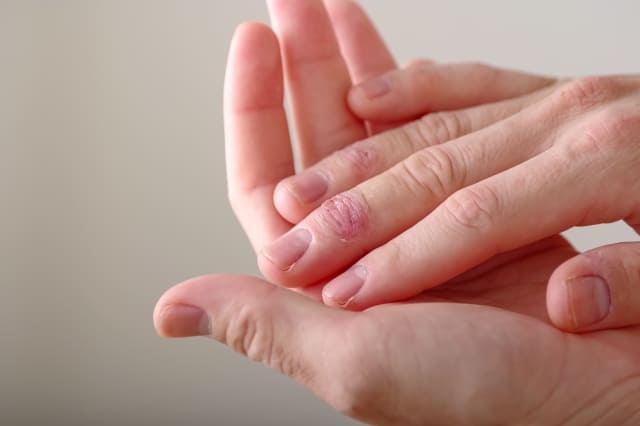 アトピー性皮膚炎