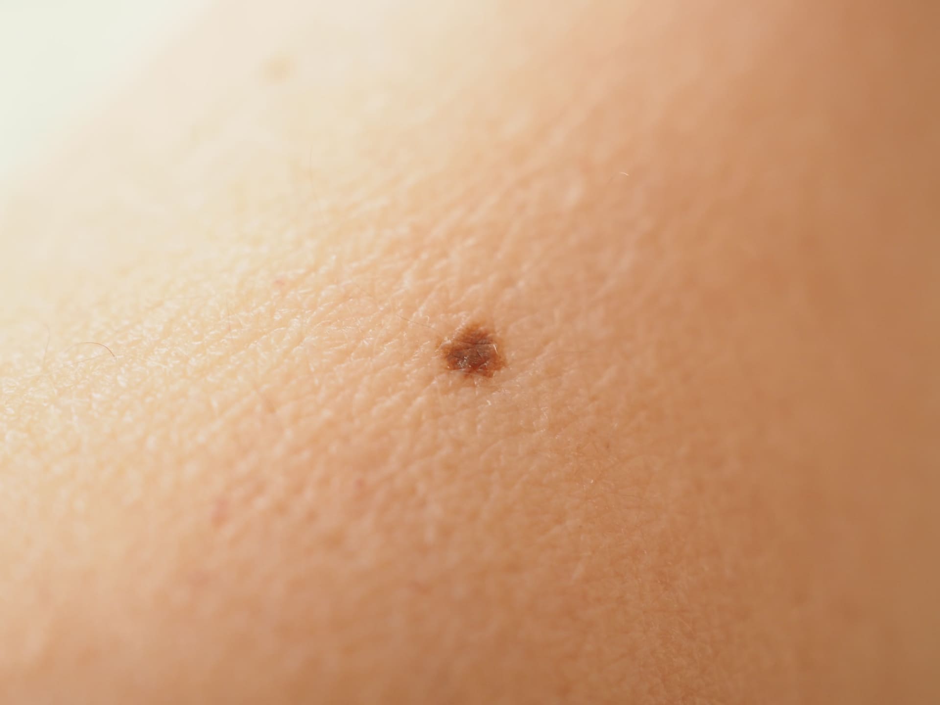 皮膚科で対応するホクロの例